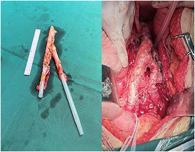 In situ repair or reconstruction of the abdominal aorta-iliac artery by autologous fascia-peritoneum with posterior rectus sheath for the treatment of the infected abdominal aortic and iliac artery aneurysms: A case series and literature review